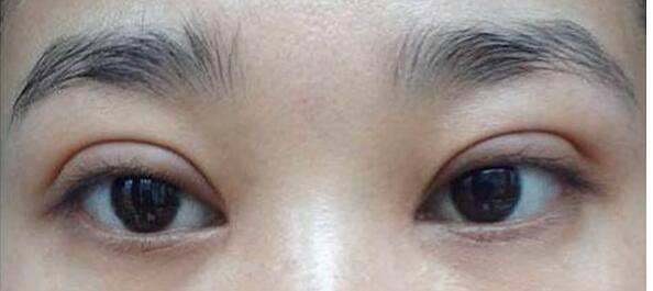 避免失??！雙眼皮手術(shù)如何避免出現(xiàn)“肉條”？