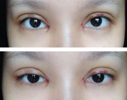 避免失??！雙眼皮手術(shù)如何避免出現(xiàn)“肉條”？