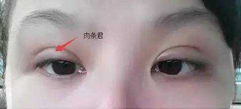 如何判斷你的雙眼皮是“真肉條”還是“假肉條”？