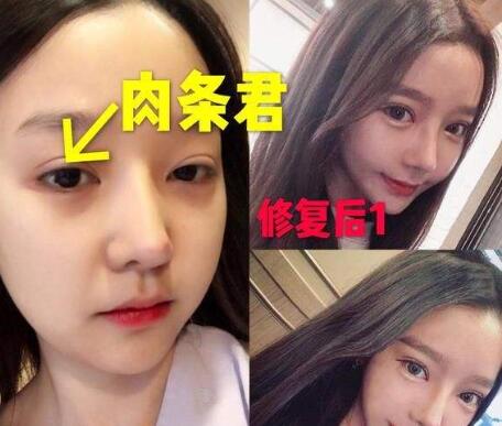 如何判斷你的雙眼皮是“真肉條”還是“假肉條”？