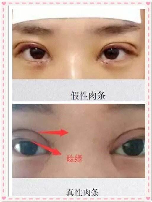 如何判斷你的雙眼皮是“真肉條”還是“假肉條”？