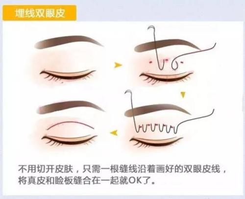 為什么不建議做埋線雙眼皮？它真的不持久！
