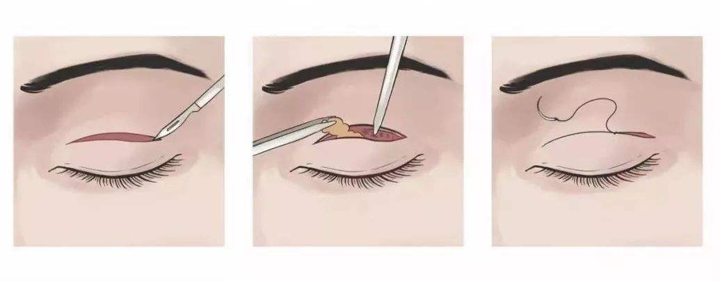 伊美爾做雙眼皮技術(shù)水平分析，7天就能恢復(fù)正常自然？