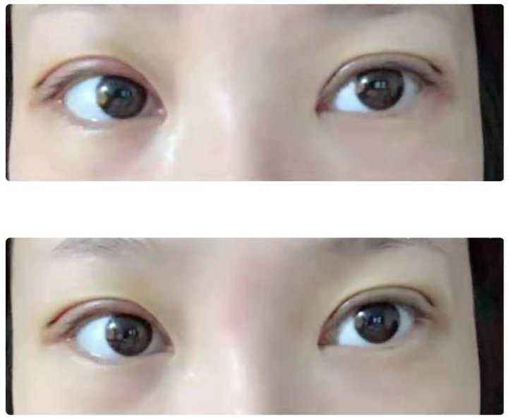 伊美爾做雙眼皮技術(shù)水平分析，7天就能恢復(fù)正常自然？
