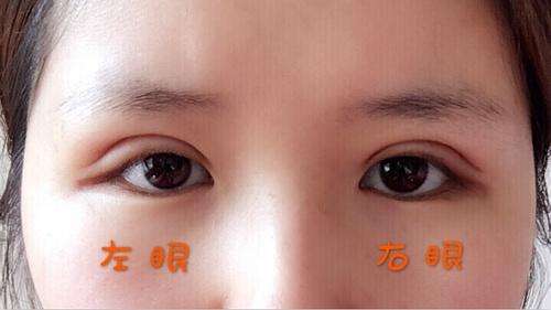 避免雙眼皮術(shù)后肉條給自己加戲！術(shù)后這些注意事項(xiàng)要做好~