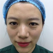 做了提眉15天啦！雙眼確實顯得精氣神許多~