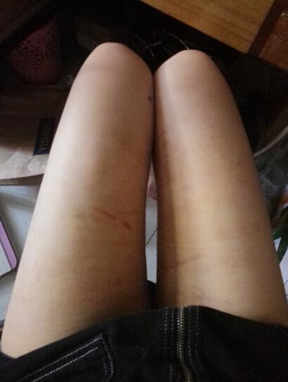 大腿吸脂案例圖