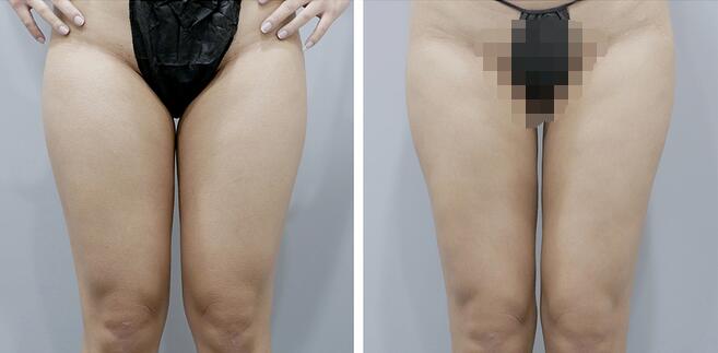 大腿吸脂案例圖