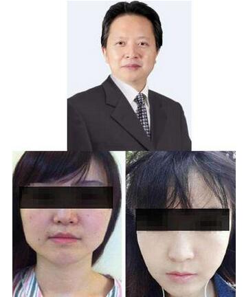 上海九院下頜角整形案例圖