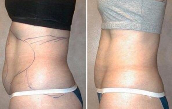 腹腰吸脂手術(shù)果圖