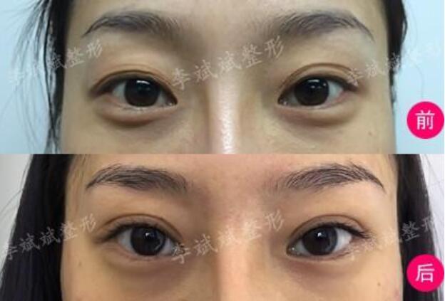 安貞醫(yī)院李斌斌雙眼皮案例圖