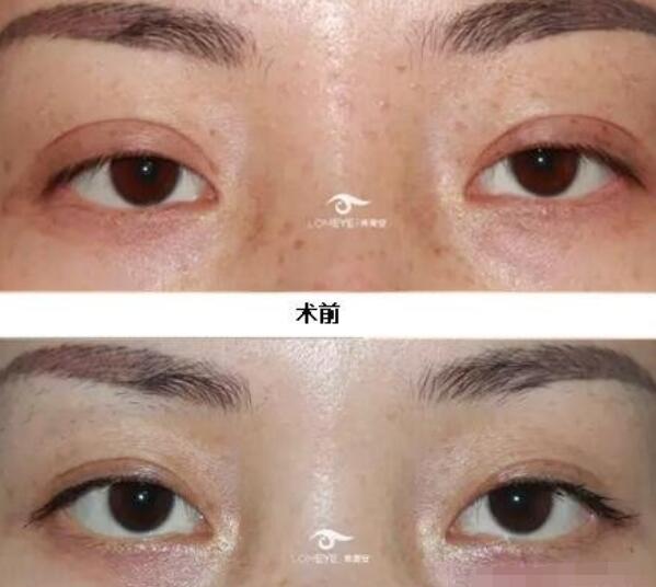 八大處靳小雷醫(yī)生雙眼皮修復(fù)案例