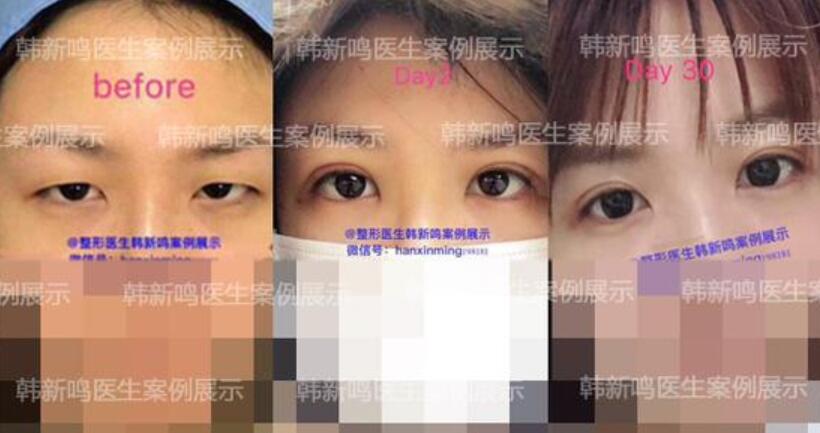 韓新鳴醫(yī)生雙眼皮案例圖