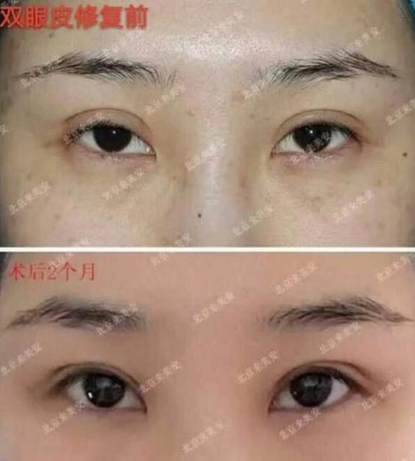 北京來(lái)美安王振軍雙眼皮修復(fù)案例圖