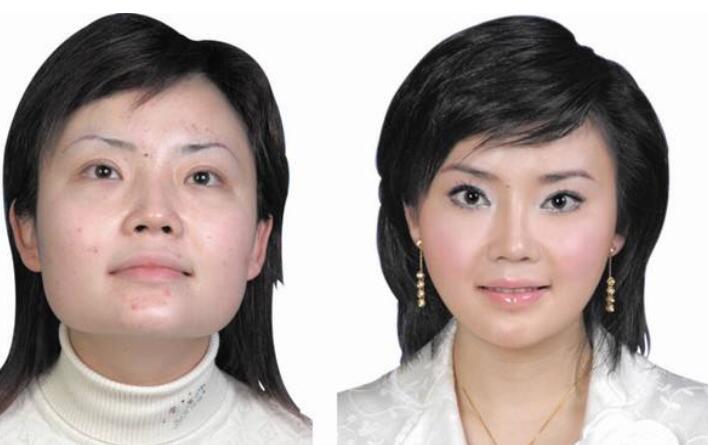 汪良明醫(yī)生下頜角整形手術(shù)案例圖