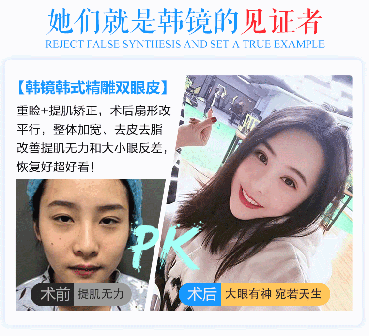 雙眼皮手術(shù)果圖