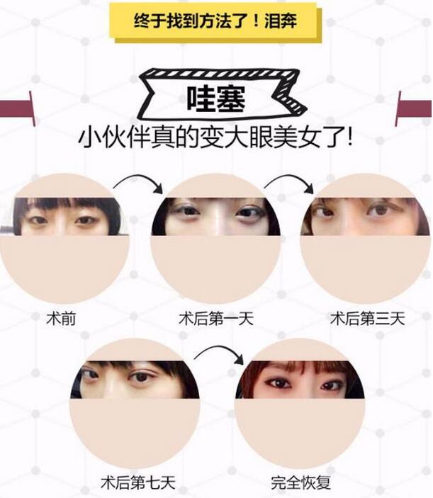 雙眼皮手術(shù)是目前比較常見的整形手術(shù)，大多數(shù)整形美容機(jī)構(gòu)都可以手術(shù)