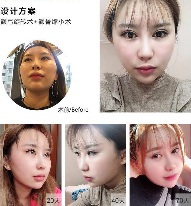 中日友好醫(yī)院高占巍醫(yī)生頜面整形案例