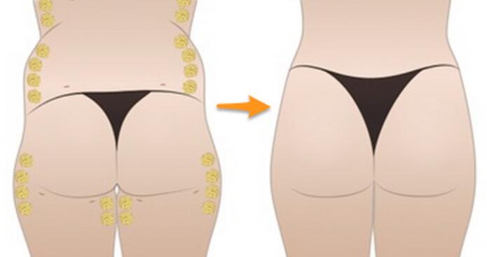 吸脂豐臀手術(shù)示意圖