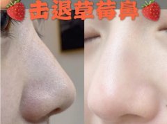 一療程果酸去黑頭的果，順便講講你們對黑頭的誤區(qū)！