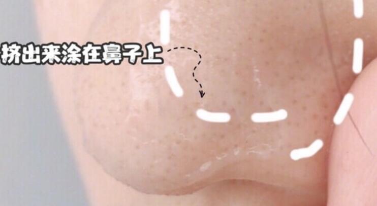 果酸去黑頭果圖