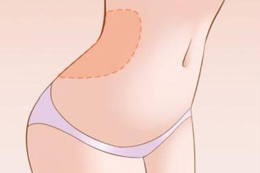 臀部吸脂手術(shù)中用到的設(shè)備不一樣，費(fèi)用也不一樣