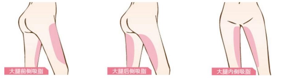 術(shù)者做完大腿吸脂手術(shù)后，并不是一勞永逸