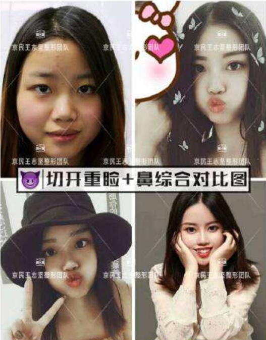 雙眼皮手術(shù)果圖