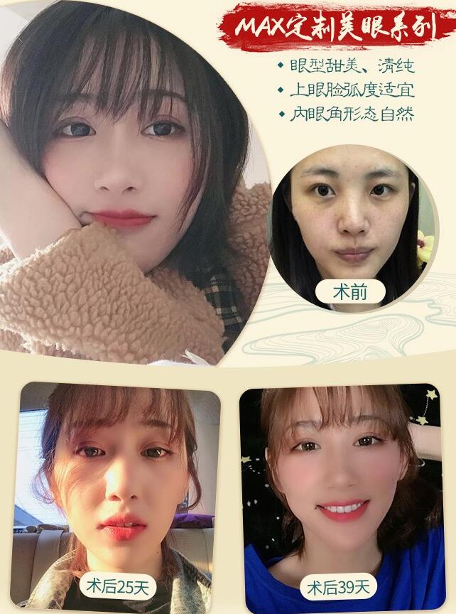 蕪湖弋磯山醫(yī)院門診整形美容科雙眼皮案例圖