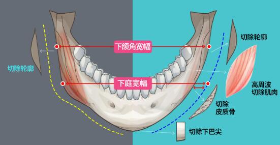 下頜角整形案例