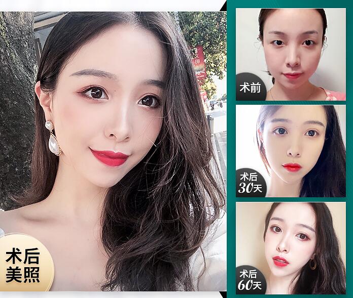 邊緣比較傾斜，末端比較鋒利的線除皺果圖