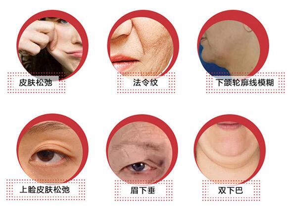 多方位分析內(nèi)窺鏡除皺術(shù)，這些你認(rèn)識(shí)多少？