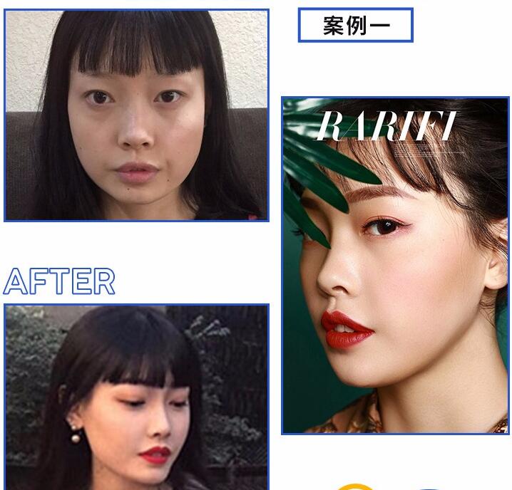 內(nèi)窺鏡除皺案例