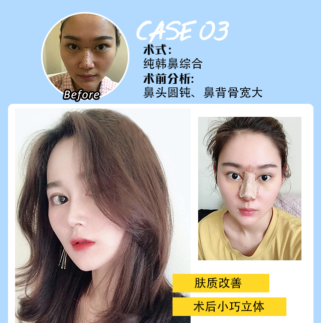 鼻頭成形術(shù)