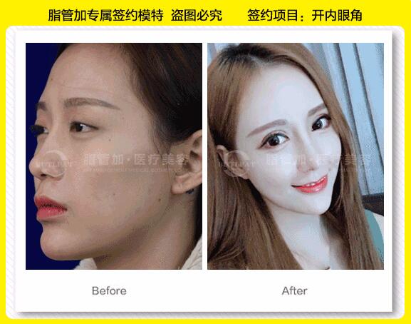 俞富興醫(yī)生開眼角案例圖