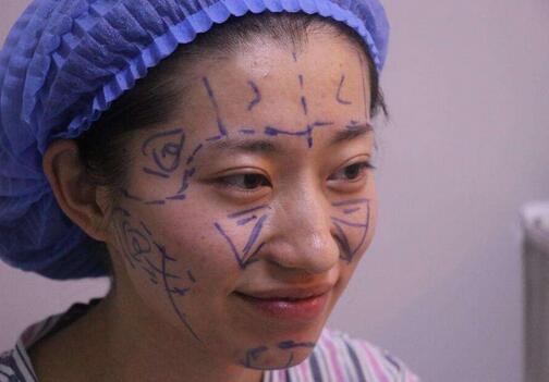 吳明瑞醫(yī)生比較擅長自體脂肪移植、新題塑形、面部五官年輕化