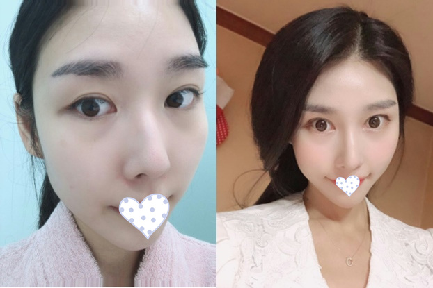 韓國,韓辰整形,醫(yī)院,口碑,雙眼皮,實例圖,