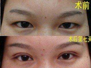 鄭州悅美整形：閆海廷醫(yī)生 簡(jiǎn)介資料 案例圖