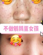 像素激光去痘做了后現(xiàn)已6個(gè)月左右了，無瑕皮膚