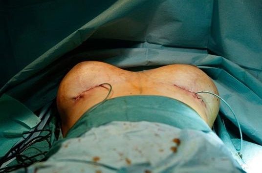 成都隆胸醫(yī)生哪個好