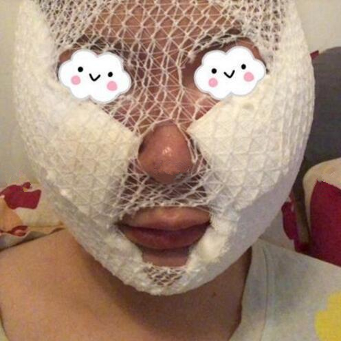 吸脂瘦臉手術(shù)果怎么樣？吸脂瘦臉和溶脂哪個好？