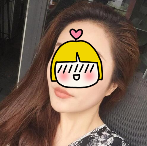 吸脂瘦臉手術(shù)果怎么樣？吸脂瘦臉和溶脂哪個好？