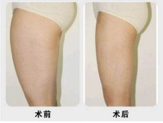 小腿吸脂減肥有什么風(fēng)險？果好嗎？