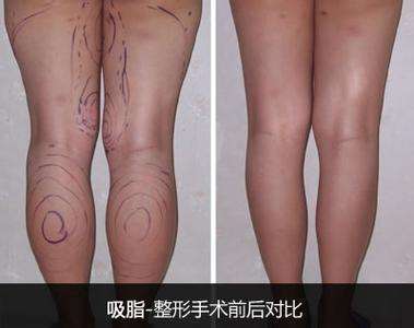 小腿吸脂減肥有什么風(fēng)險？果好嗎？