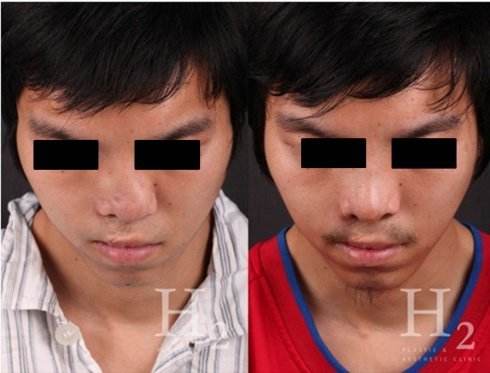 假體隆鼻失敗修復手術(shù)有哪些方法？