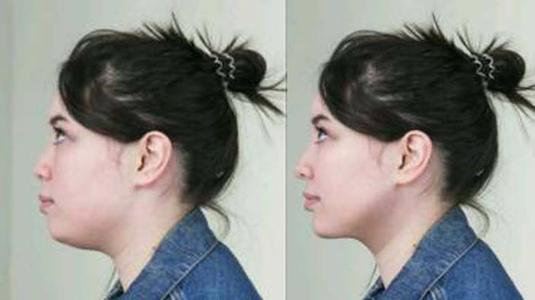 假體隆鼻失敗修復手術(shù)有哪些方法？