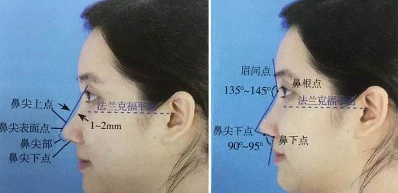 假體隆鼻失敗修復手術(shù)有哪些方法？