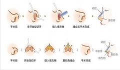 鼻翼縮小手術恢復期間應該注意的這些事兒~