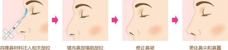 北京注射隆鼻多少錢？哪個(gè)品牌的玻尿酸隆鼻果好？