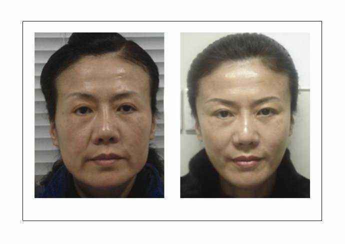 鼻唇溝填充能維持多久？可以選擇哪些材料？